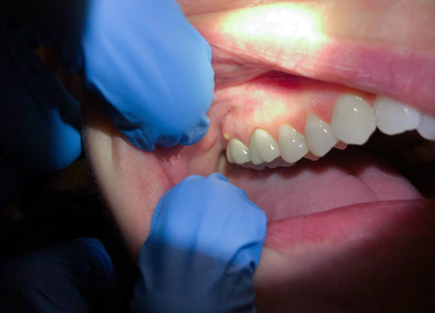 Best Knocked-Out Tooth (Avulsed Tooth) Treatment in Telford, PA